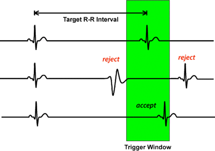 cardiac MRI trigger window