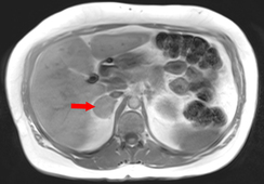 In-phase/Out-of-phase MRI: adrenal adenoma