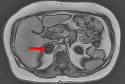 In-phase/Out-of-phase MRI: adrenal adenoma