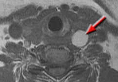 MRI protein, mucin, colloids, short T1