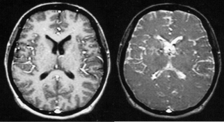 MRI spoiling GRE images brain