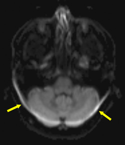 Chemical Shift Artifact in EPI