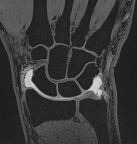 gadolinium arthrogram