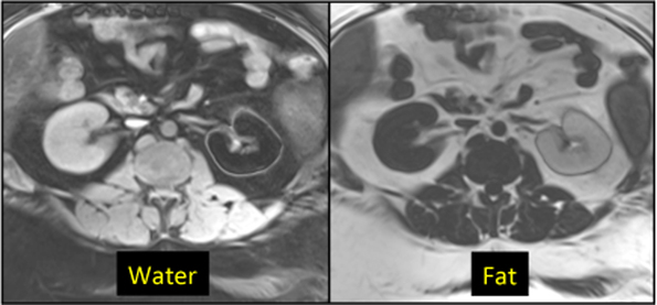 Dixon method MRI, IDEAL