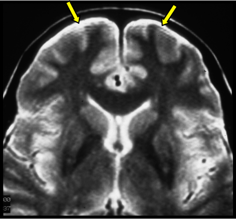 Gibbs artifact? - Questions and Answers in MRI