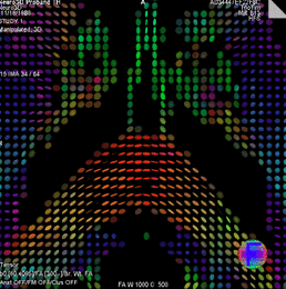 Diffusion tensor MRI