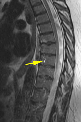 Star artifact MRI
