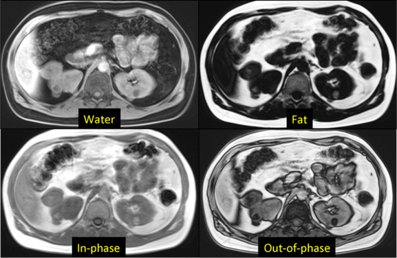 Dixon method MRI