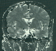 T2 brain map
