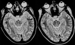 Fast SE/Turbo SE decreased susceptibility