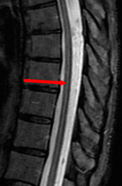 Gibbs (Truncation) Artifact