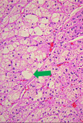 adrenal adenoma