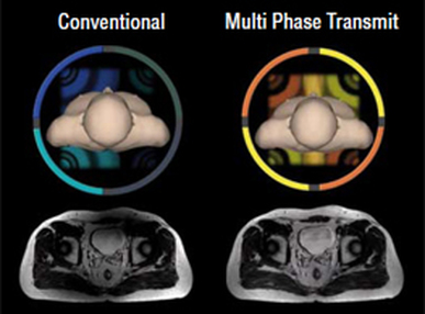 parallel transmit MRI