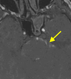 Shine-through Artifacts in MRA