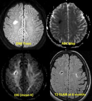 Diffusion kurtosis imaging (DKI)