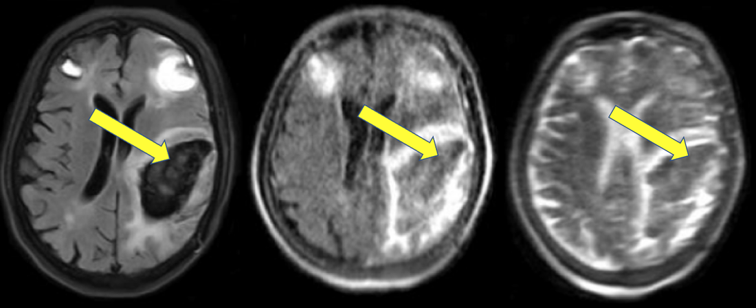 Low-field 0.064T MRI of hemorrhage